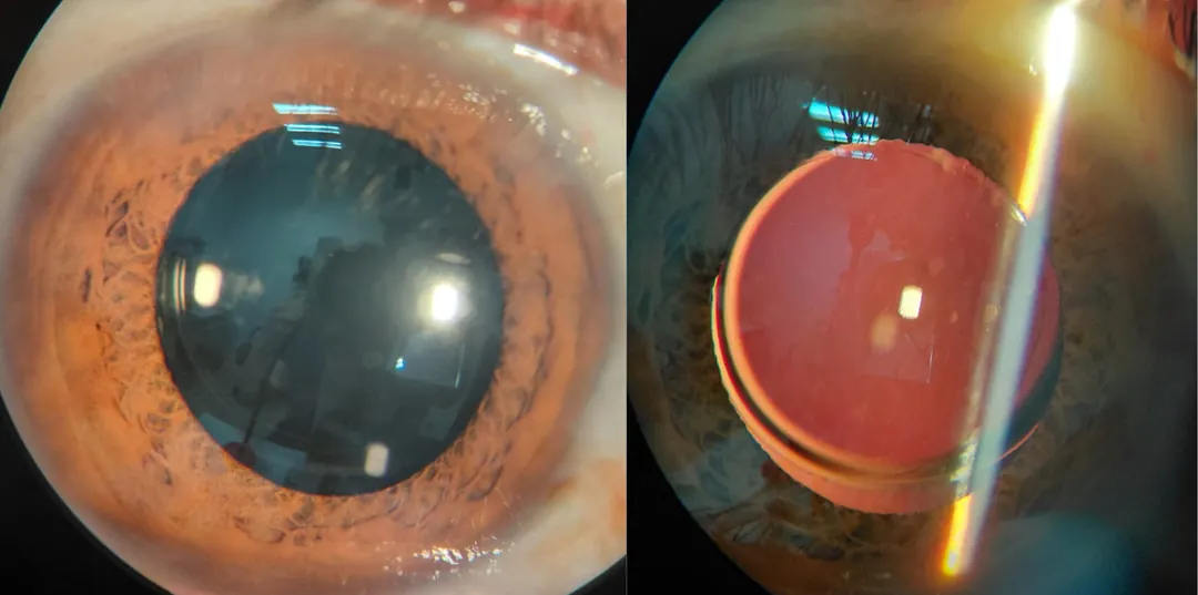 Lente intraocular implantado — Dr. Alberto Oscar Eng Wu